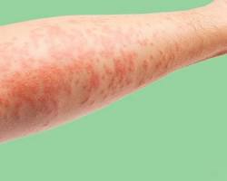 Atopik Dermatit Şanlıurfa Çocuk Doktoru